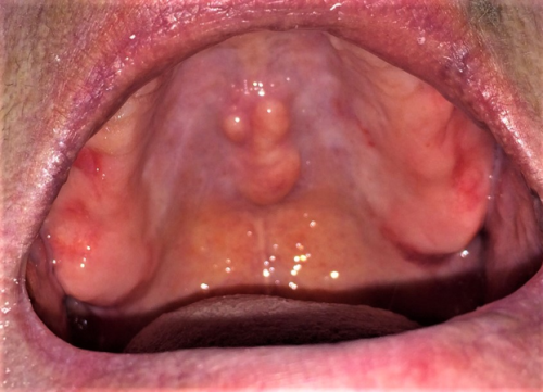 Individuele lepels & gipstechniek 1