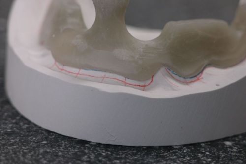 Individuele lepels & gipstechniek 1