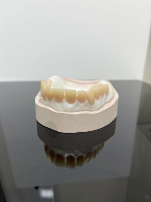 NEW Make It Your Way - Hybride Denture Workflow met live patiënt