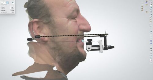 NEW Make It Your Way - Hybride Denture Workflow met live patiënt