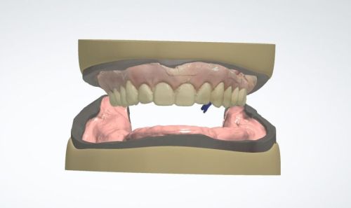 NEW Make It Your Way - Hybride Denture Workflow met live patiënt
