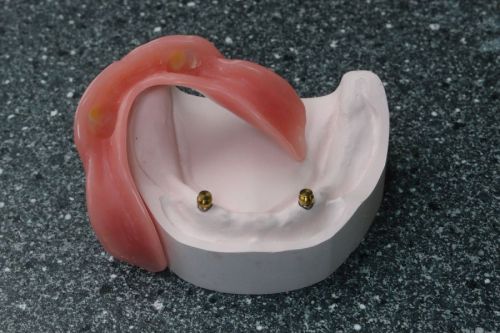 Relining op implantaten