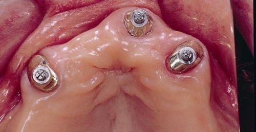 Relining op implantaten