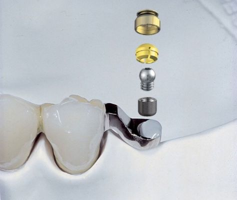 Relining op implantaten